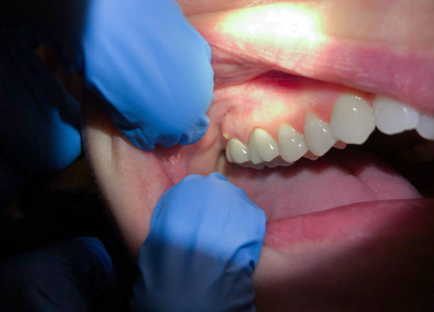 Best Emergency Tooth Extraction in Natchez, MS